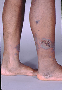 Cutaneous polyarteritis nodosa